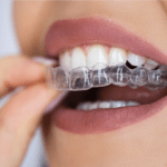 01-Aligners - Aesthetic