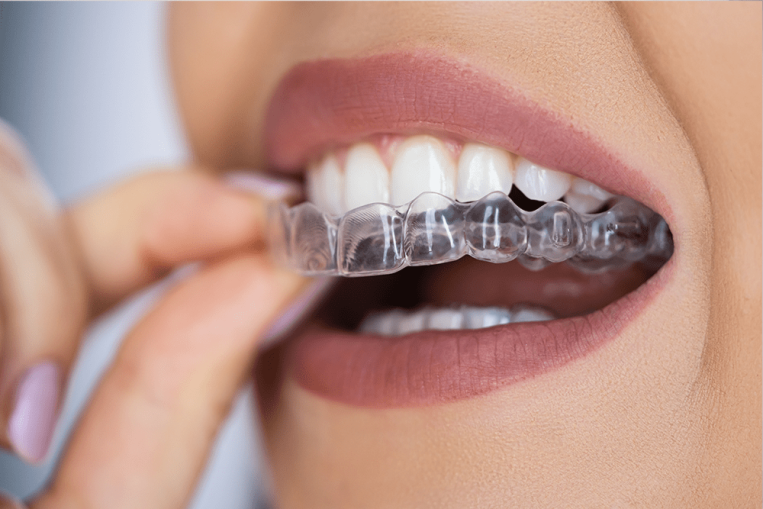 01-Aligners