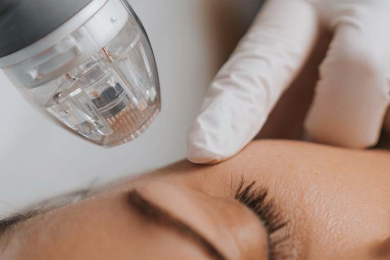 02-RF-Microneedling